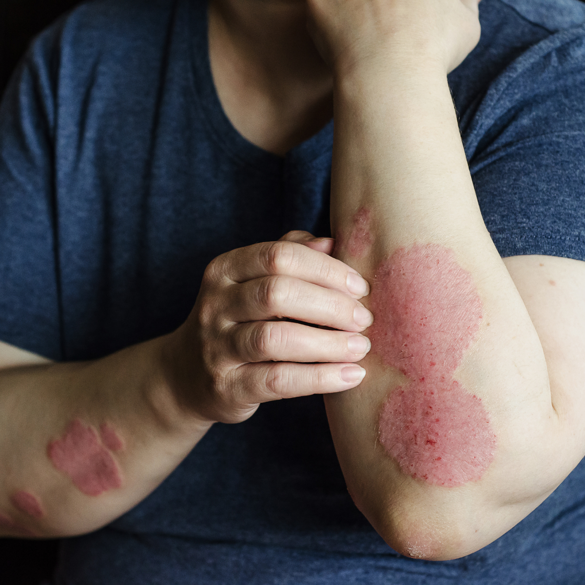 Psoriasis
